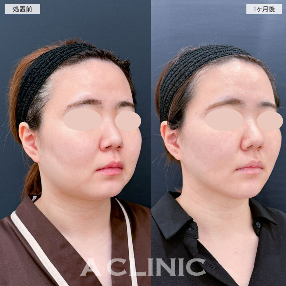 1day小顔脂肪吸引とバッカルファット除去術でどこから見てもひと回り小顔に！処置前と1ヶ月後の症例です(20代女性)