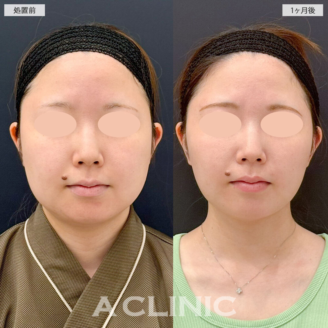 1day小顔脂肪吸引と小顔エラボトックスで卵型の輪郭をゲット！こちら処置前と１ヶ月後の症例です(20代女性)