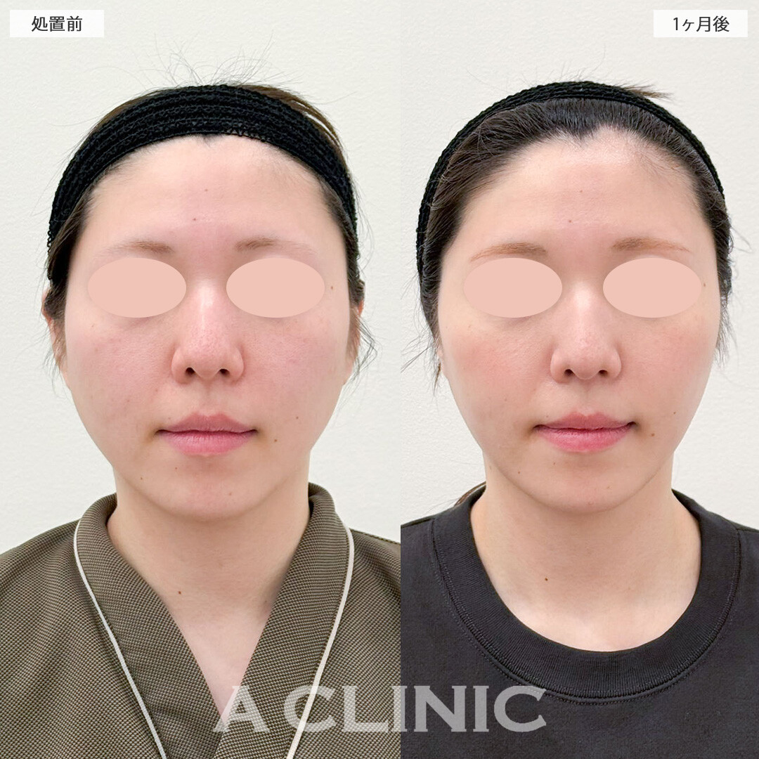 1day小顔脂肪吸引でフェイスラインがくっきり出現しました！こちら処置前と１ヶ月後の症例です(20代女性)