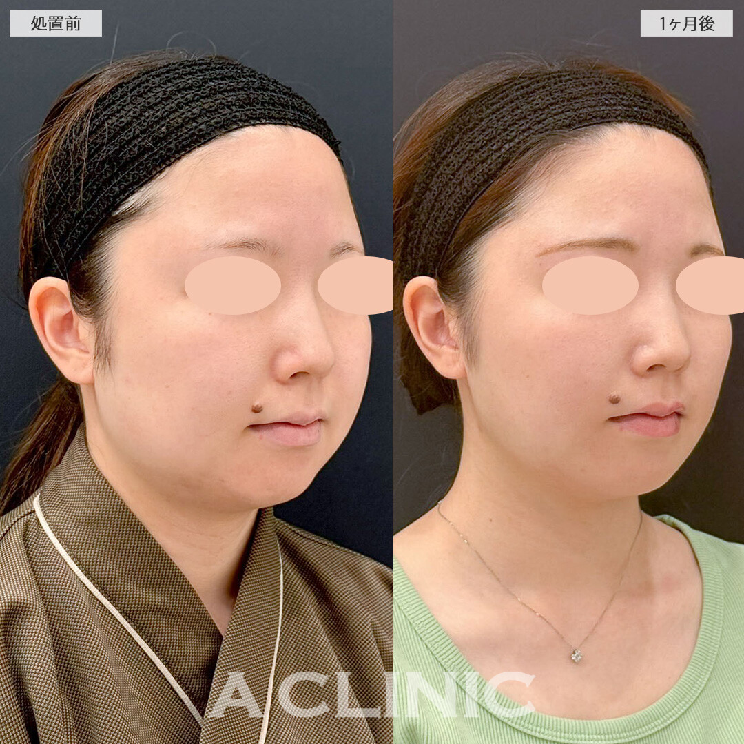 1day小顔脂肪吸引と小顔エラボトックスで卵型の輪郭をゲット！こちら処置前と１ヶ月後の症例です(20代女性)