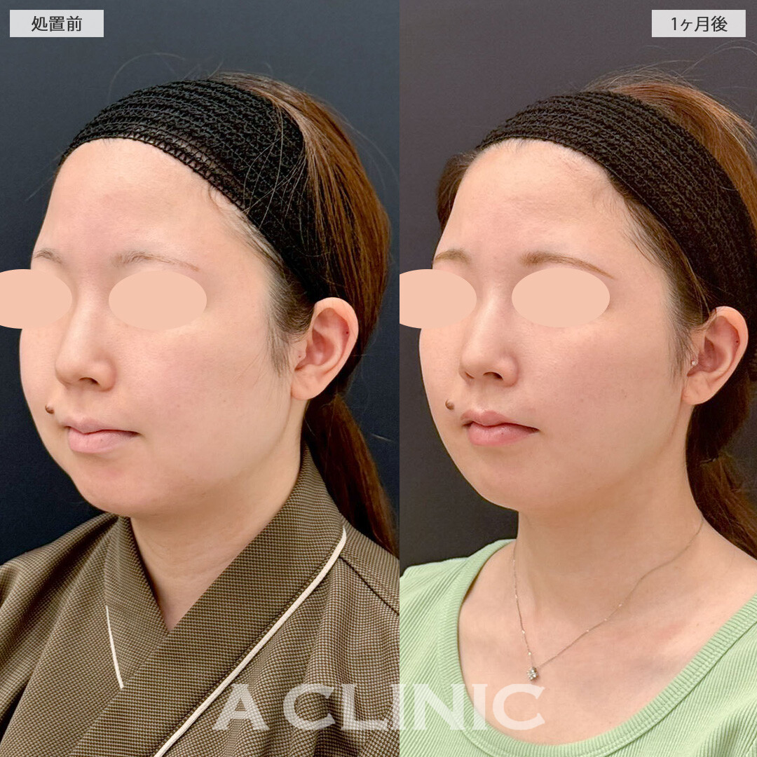 1day小顔脂肪吸引と小顔エラボトックスで卵型の輪郭をゲット！こちら処置前と１ヶ月後の症例です(20代女性)