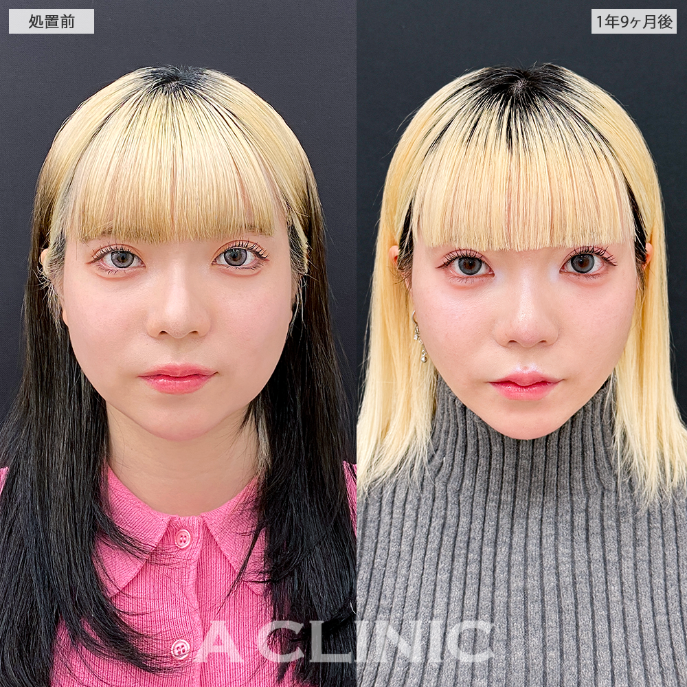 1day小顔脂肪吸引でフェイスラインが整い加工不要な輪郭になりました！こちら処置前と1年9ヶ月後の症例です(20代女性)