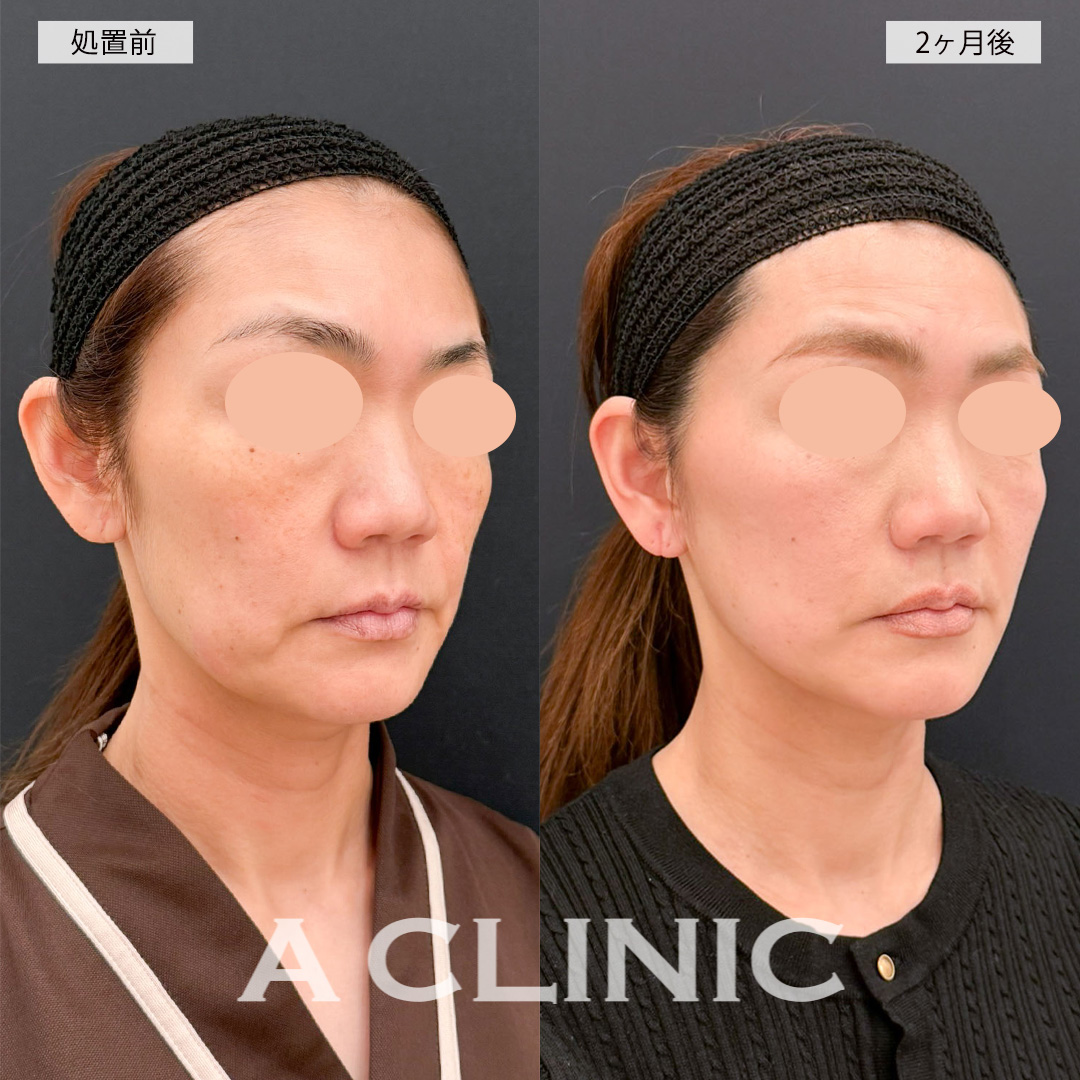 【直後の傷跡あり】A式美肌たるみ切開を行ったことでたるみが改善され自然な若返りに成功！こちら処置前から2ヶ月後までの症例です(40代女性)