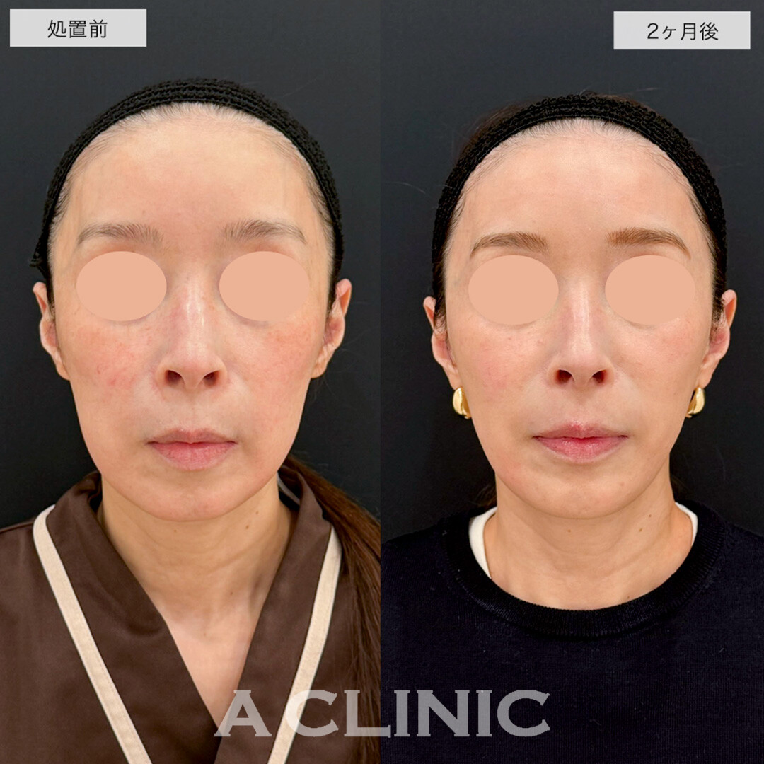 1day小顔脂肪吸引で余白を減らし綺麗にリフトアップ!こちら処置前と2ヶ月後の症例です(50代女性)
