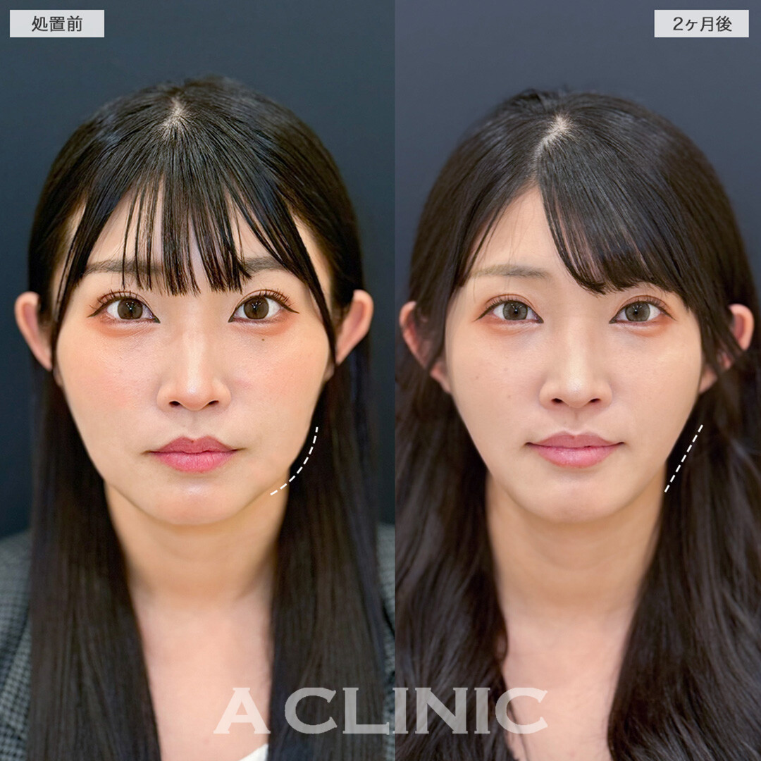 1day小顔脂肪吸引でフェイスラインのぼやけが解消し全方位爆盛れ！こちら処置前と2ヶ月後の症例です(30代女性)