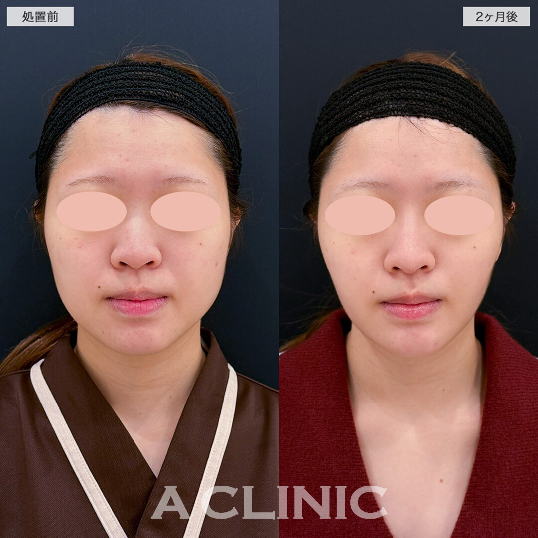 1day小顔脂肪吸引とバッカルファット除去術で余白すっきり！こちら処置前と2ヶ月後の症例です(20代女性)