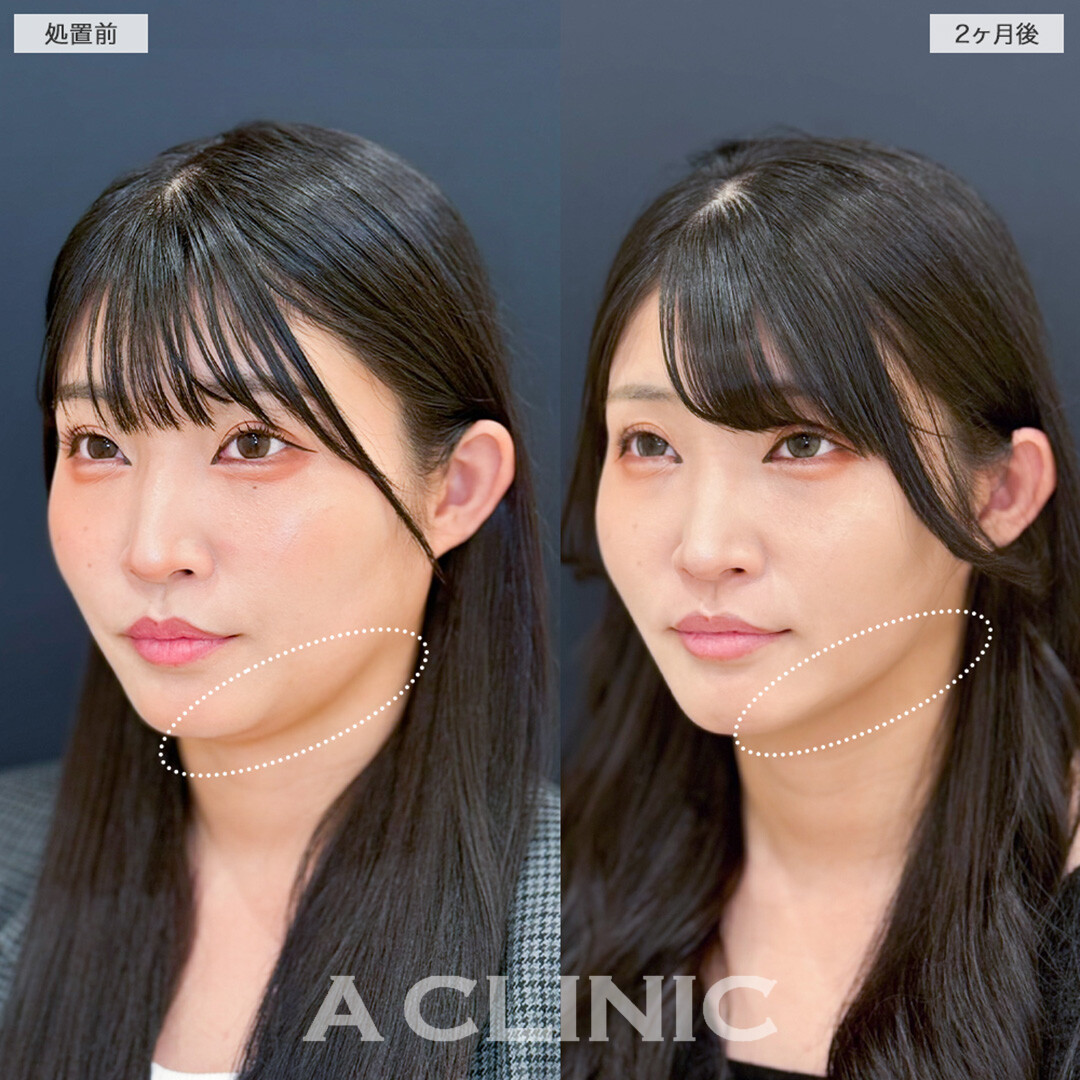 1day小顔脂肪吸引でフェイスラインのぼやけが解消し全方位爆盛れ！こちら処置前と2ヶ月後の症例です(30代女性)