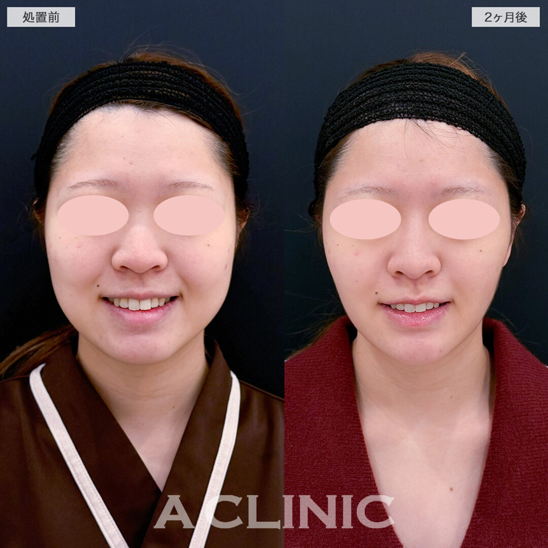1day小顔脂肪吸引とバッカルファット除去術で余白すっきり！こちら処置前と2ヶ月後の症例です(20代女性)