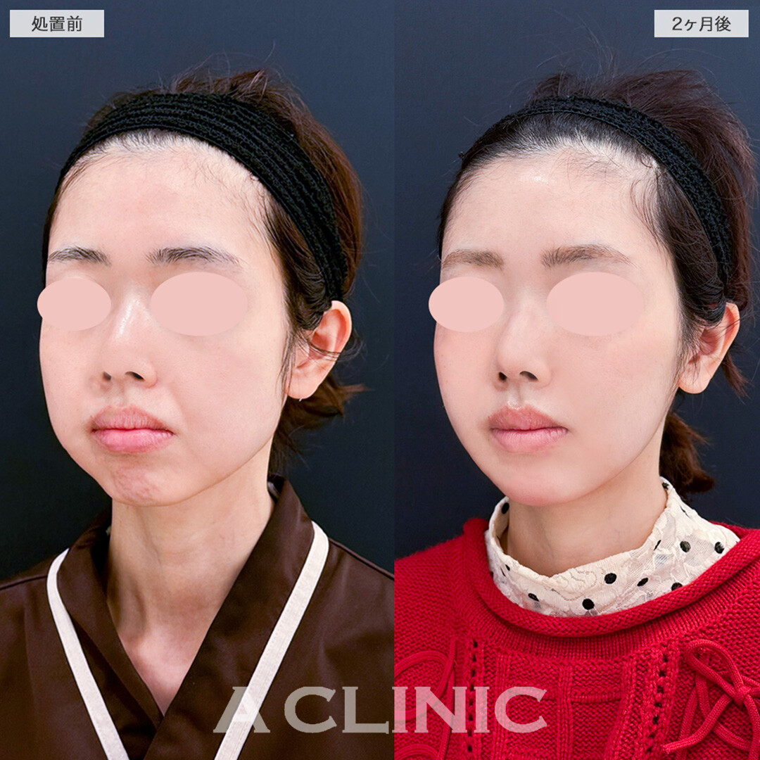 1day小顔脂肪吸引と小顔エラボトックスでここまで輪郭整えられます！こちら処置前と2ヶ月後の症例です。(30代女性)