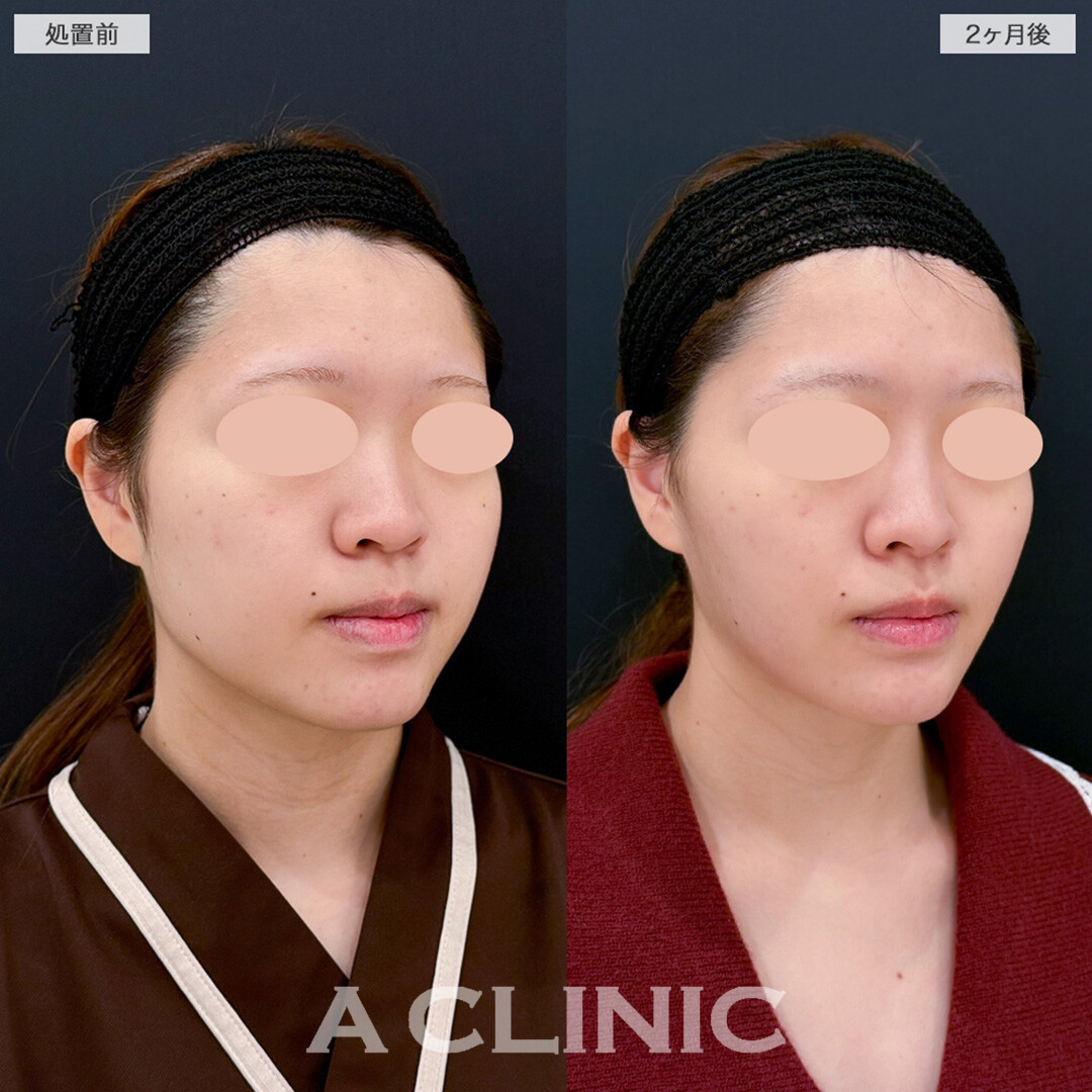 1day小顔脂肪吸引とバッカルファット除去術で余白すっきり！こちら処置前と2ヶ月後の症例です(20代女性)
