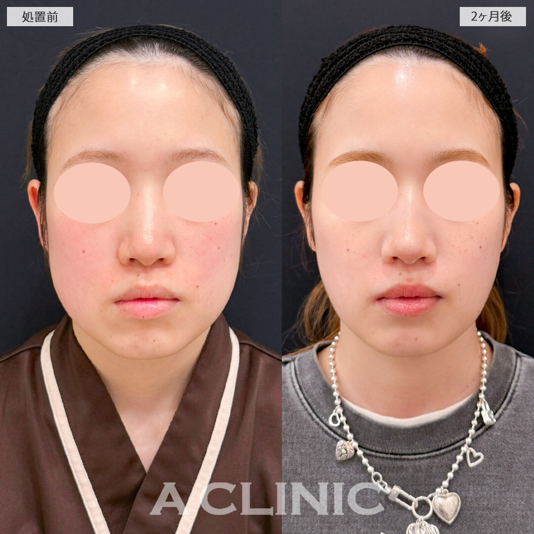 1day小顔脂肪吸引とバッカルファット除去術で笑った時も輪郭がキレイなまま！処置前と2ヶ月後の症例です(30代女性)
