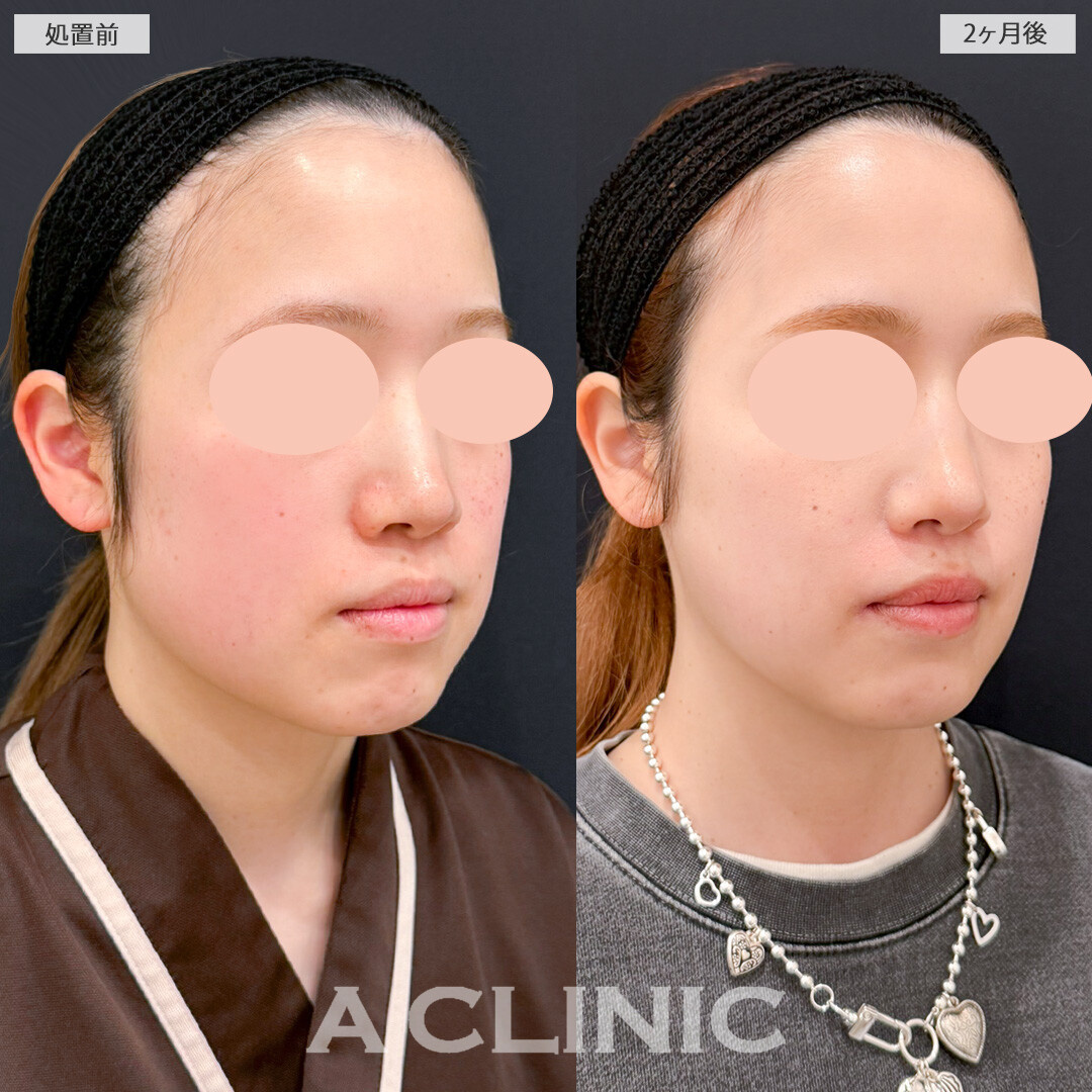 1day小顔脂肪吸引とバッカルファット除去術で笑った時も輪郭がキレイなまま！処置前と2ヶ月後の症例です(30代女性)
