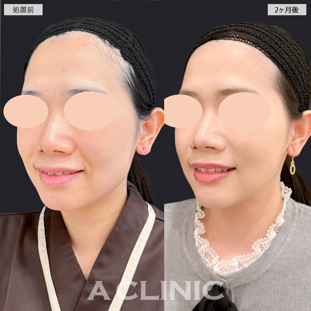 1day小顔脂肪吸引とバッカルファット除去術とあごへのヒアルロン酸注入でシュッとしたシャープな輪郭を手にれました！処置前と2ヶ月後の症例です(30代女性)