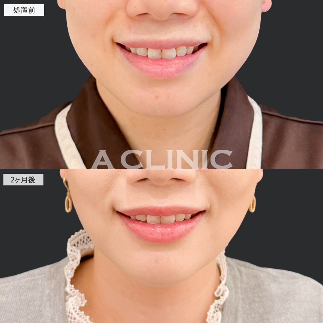 1day小顔脂肪吸引とバッカルファット除去術とあごへのヒアルロン酸注入でシュッとしたシャープな輪郭を手にれました！処置前と2ヶ月後の症例です(30代女性)