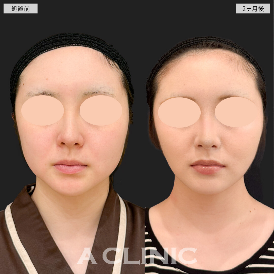 1day小顔脂肪吸引とバッカルファット除去術と小顔エラボトックスでどの角度からもスッキリ整った輪郭になりました！処置前と2ヶ月後の症例です(20代女性)