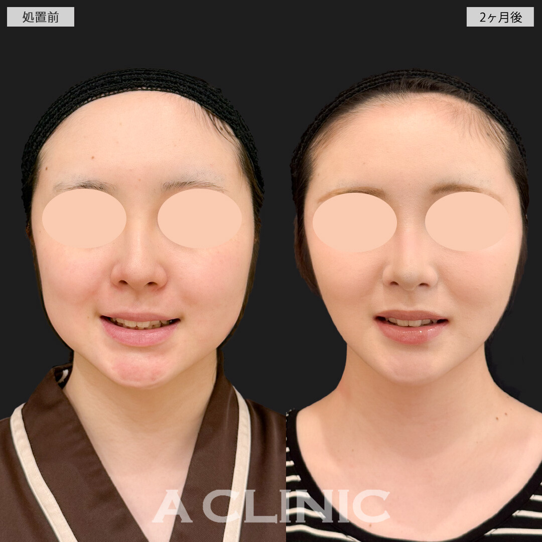 1day小顔脂肪吸引とバッカルファット除去術と小顔エラボトックスでどの角度からもスッキリ整った輪郭になりました！処置前と2ヶ月後の症例です(20代女性)