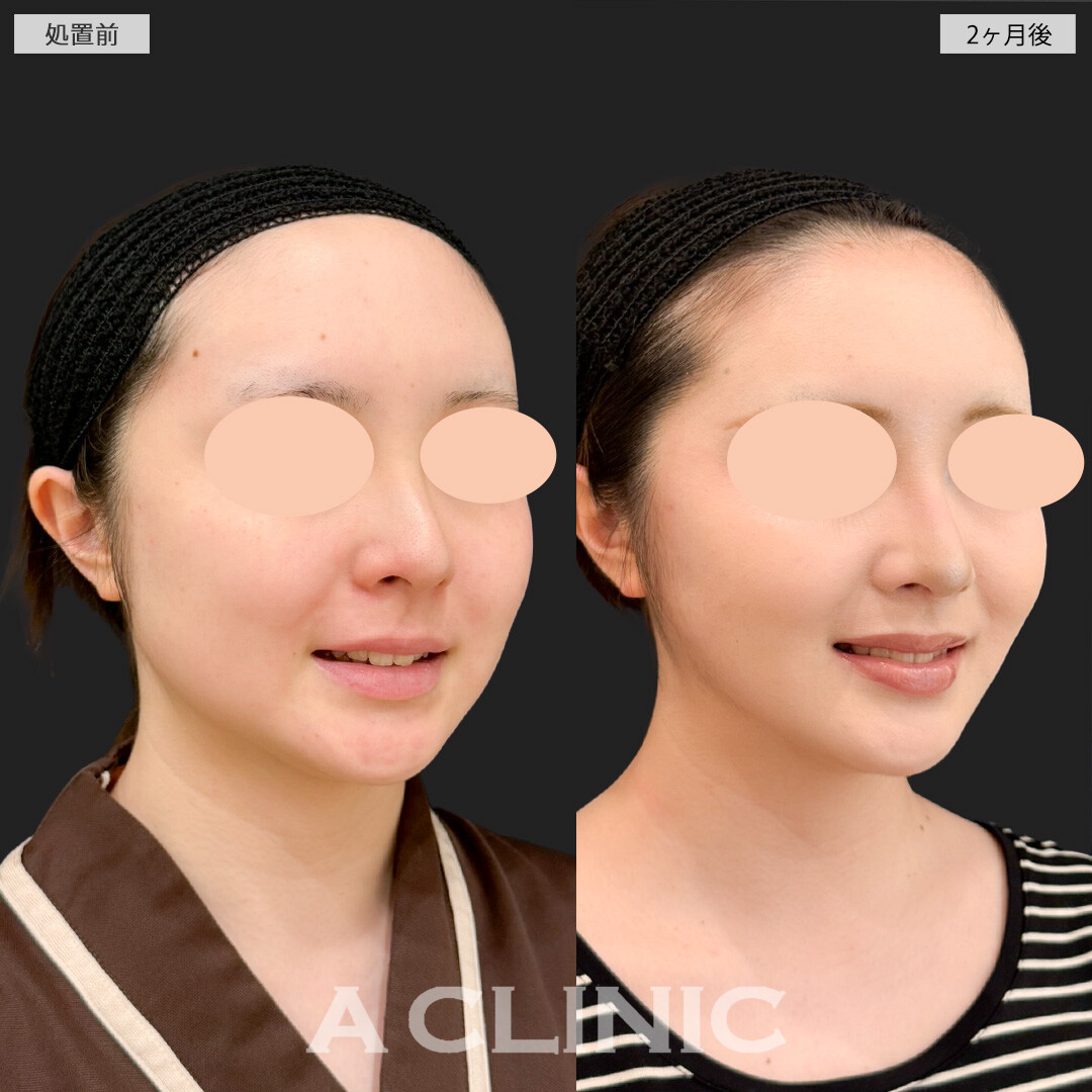 1day小顔脂肪吸引とバッカルファット除去術と小顔エラボトックスでどの角度からもスッキリ整った輪郭になりました！処置前と2ヶ月後の症例です(20代女性)