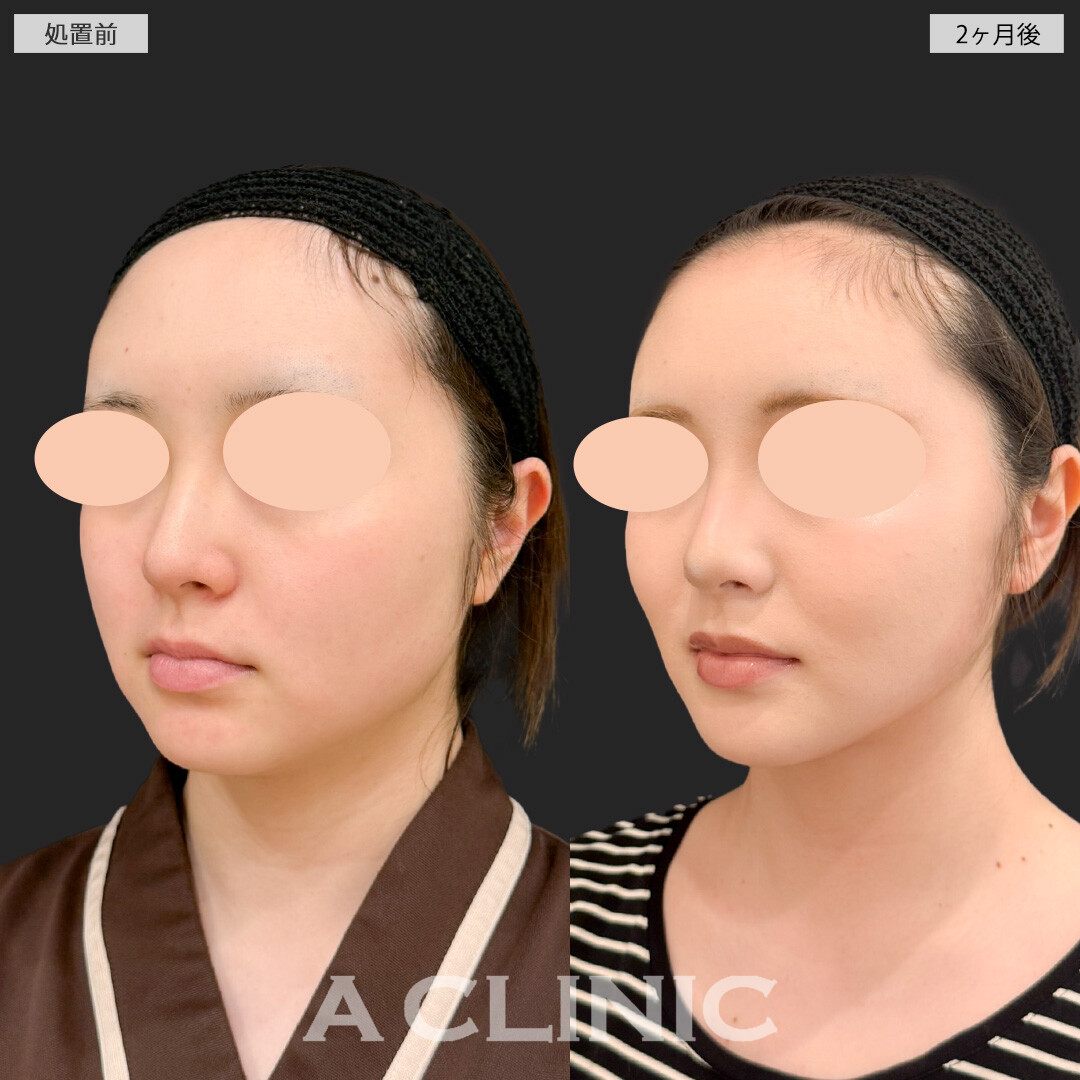 1day小顔脂肪吸引とバッカルファット除去術と小顔エラボトックスでどの角度からもスッキリ整った輪郭になりました！処置前と2ヶ月後の症例です(20代女性)