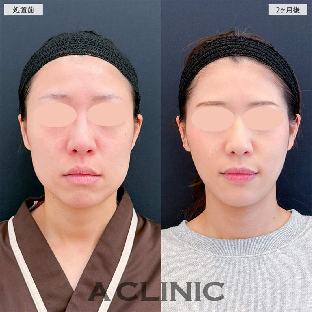 1day小顔脂肪吸引とバッカルファット除去術で周りから驚かれるほど変わりました！こちら処置前と2ヶ月後の症例です(20代女性)