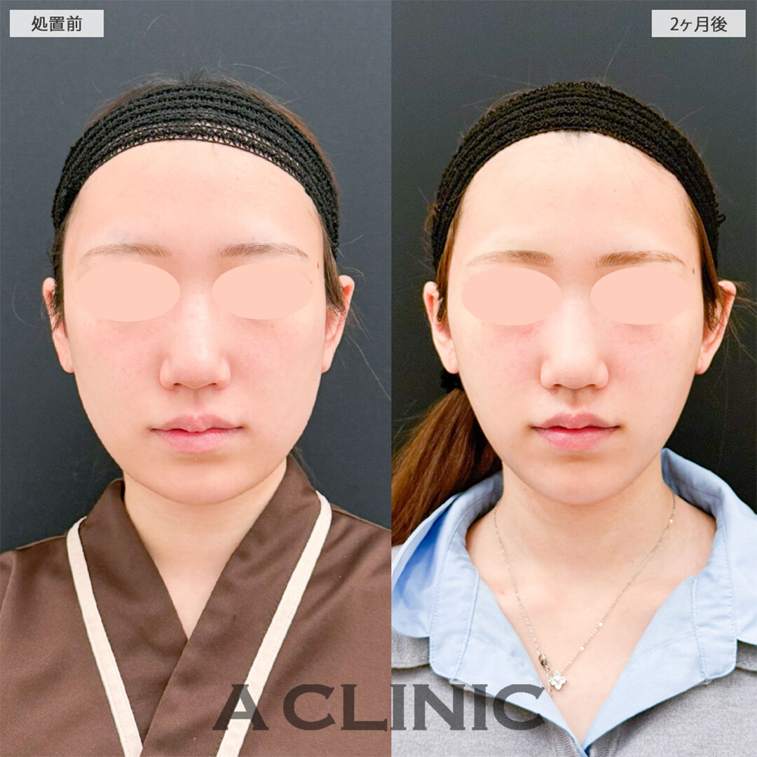 1day小顔脂肪吸引と小顔エラボトックスで周りから褒められる輪郭になりました！こちら処置前と2ヶ月後の症例です(20代女性)