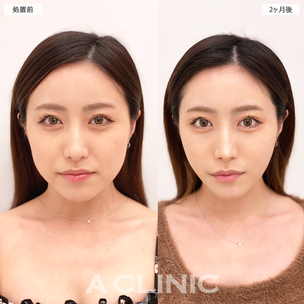 1day小顔脂肪吸引でフェイスラインが整い綺麗なEラインになりました！こちら処置前と2ヶ月後の症例です(30代女性)