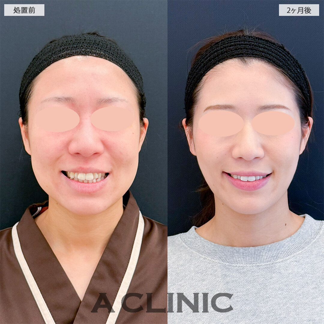 1day小顔脂肪吸引とバッカルファット除去術で周りから驚かれるほど変わりました！こちら処置前と2ヶ月後の症例です(20代女性)