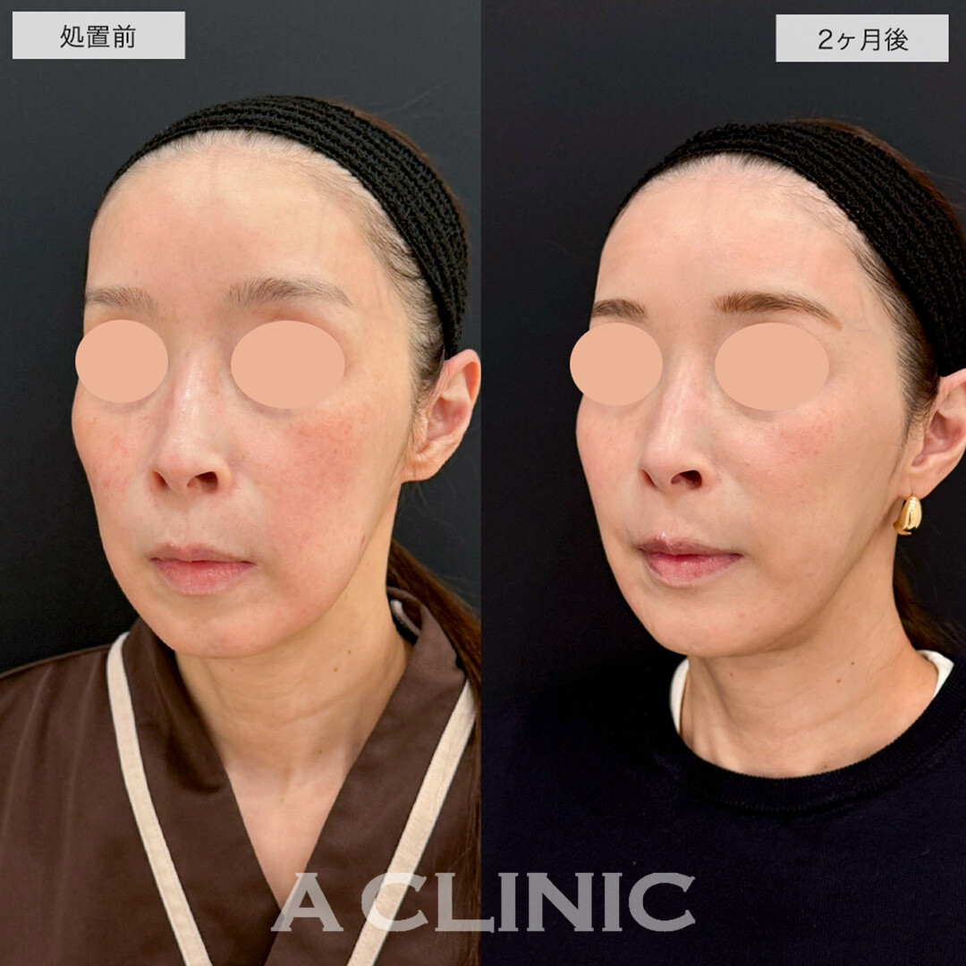 1day小顔脂肪吸引で余白を減らし綺麗にリフトアップ!こちら処置前と2ヶ月後の症例です(50代女性)