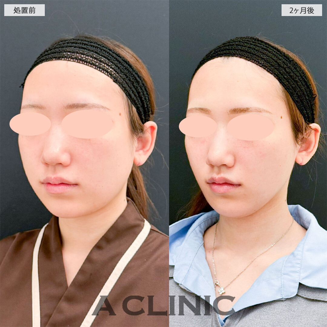 1day小顔脂肪吸引と小顔エラボトックスで周りから褒められる輪郭になりました！こちら処置前と2ヶ月後の症例です(20代女性)