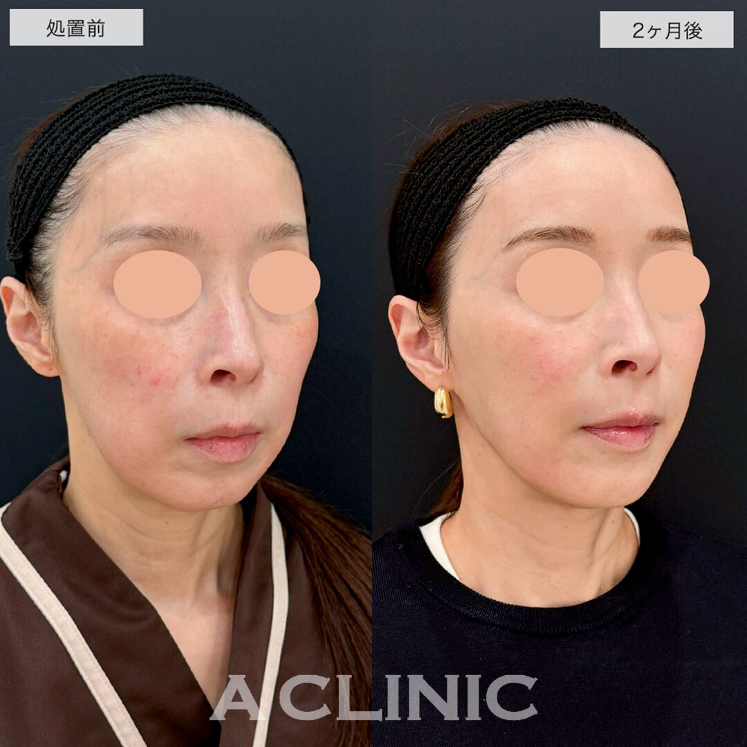 1day小顔脂肪吸引で余白を減らし綺麗にリフトアップ!こちら処置前と2ヶ月後の症例です(50代女性)