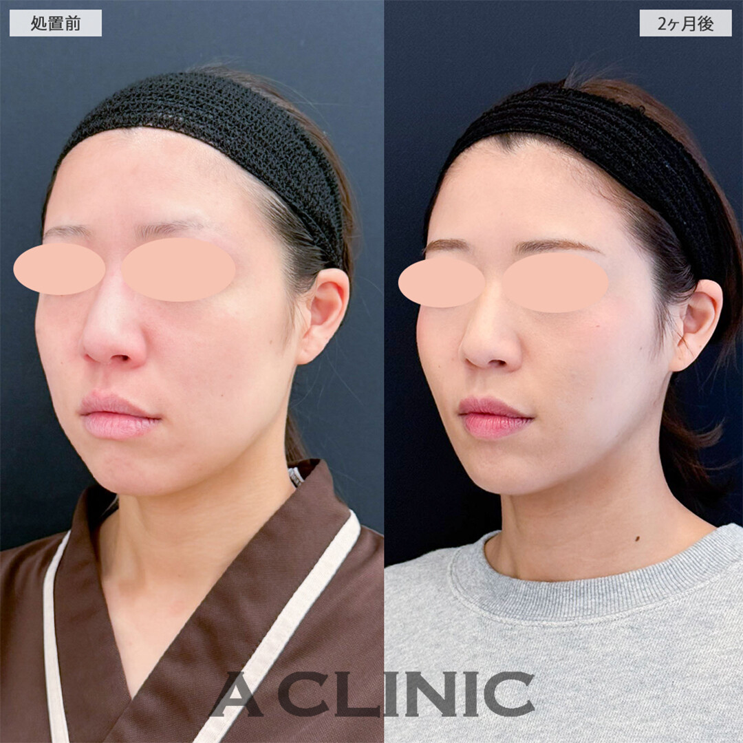 1day小顔脂肪吸引とバッカルファット除去術で周りから驚かれるほど変わりました！こちら処置前と2ヶ月後の症例です(20代女性)