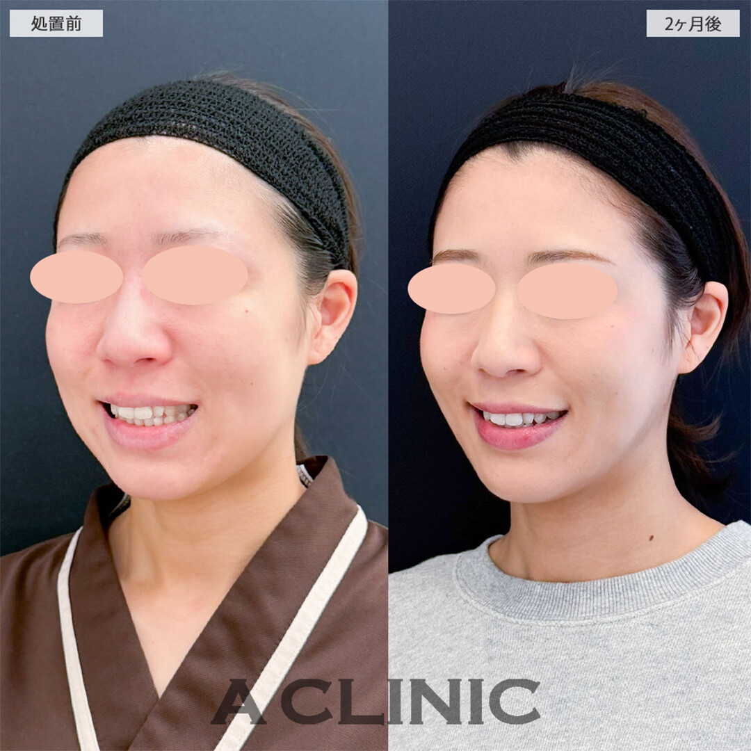 1day小顔脂肪吸引とバッカルファット除去術で周りから驚かれるほど変わりました！こちら処置前と2ヶ月後の症例です(20代女性)