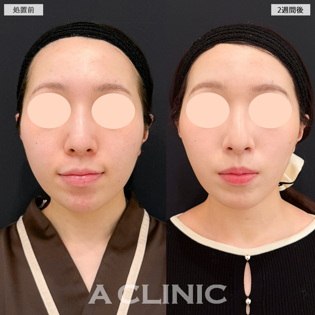 1day小顔脂肪吸引とバッカルファット除去術でスッキリさせつつ輪郭のバランスも整えてくれます！処置前と2週間後の症例です(20代女性)