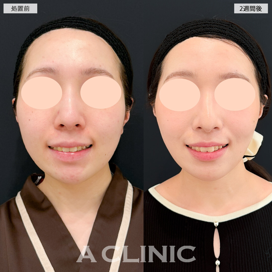 1day小顔脂肪吸引とバッカルファット除去術でスッキリさせつつ輪郭のバランスも整えてくれます！処置前と2週間後の症例です(20代女性)