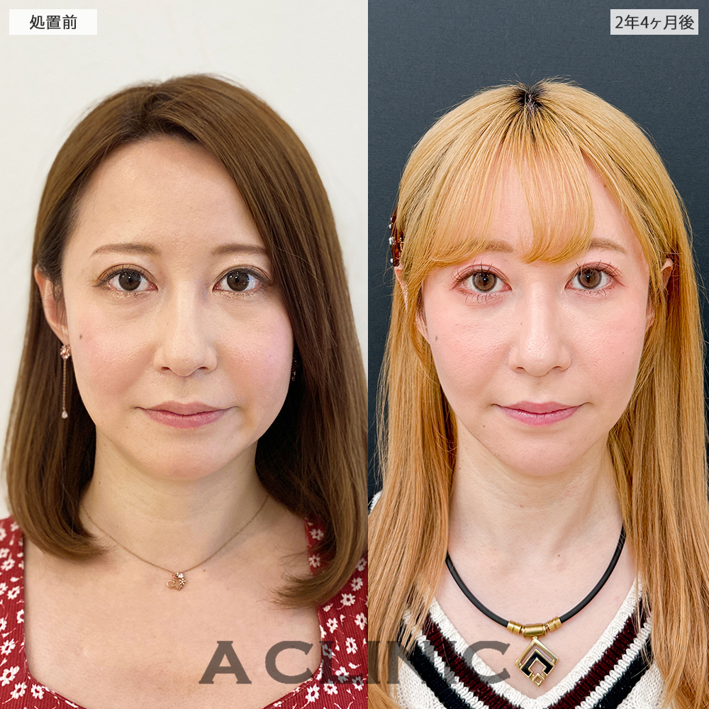 1day小顔脂肪吸引なら長期経過後も美しい輪郭をキープ！処置前と2年4ヶ月後の症例です(30代女性)