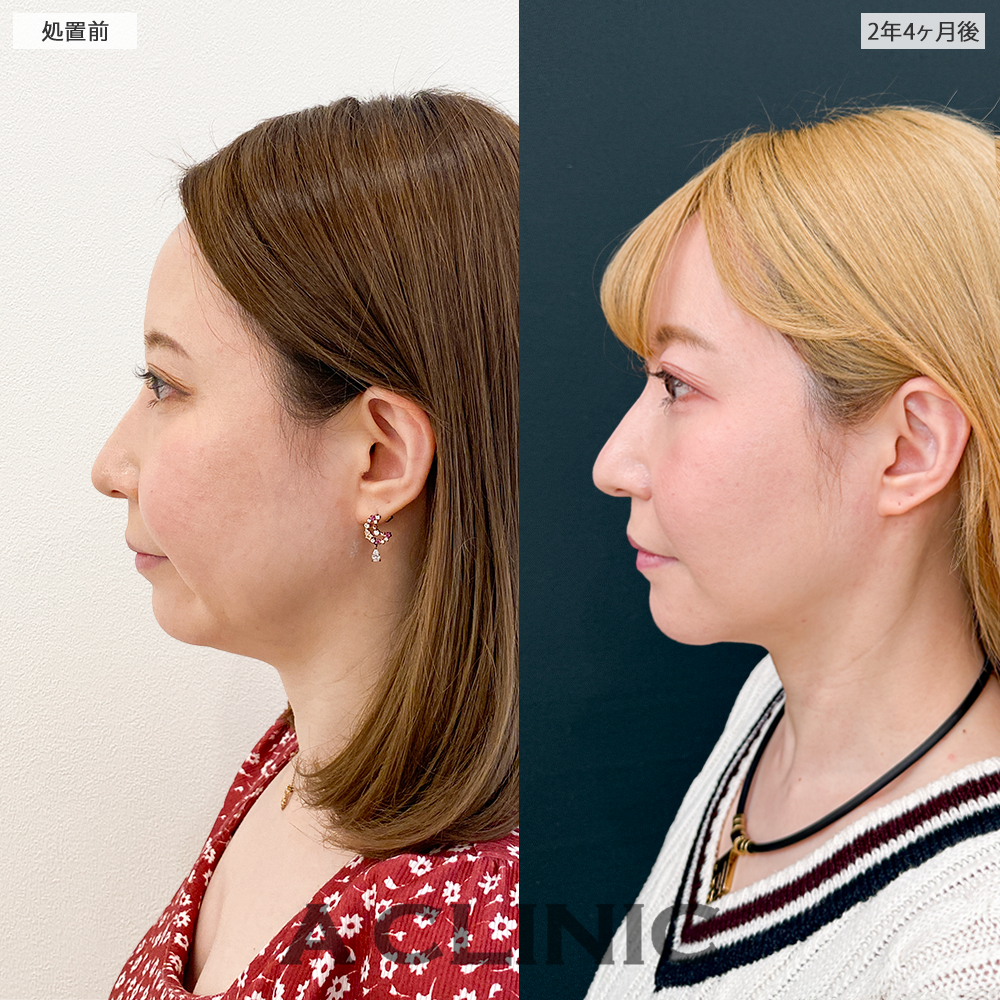 1day小顔脂肪吸引なら長期経過後も美しい輪郭をキープ！処置前と2年4ヶ月後の症例です(30代女性)