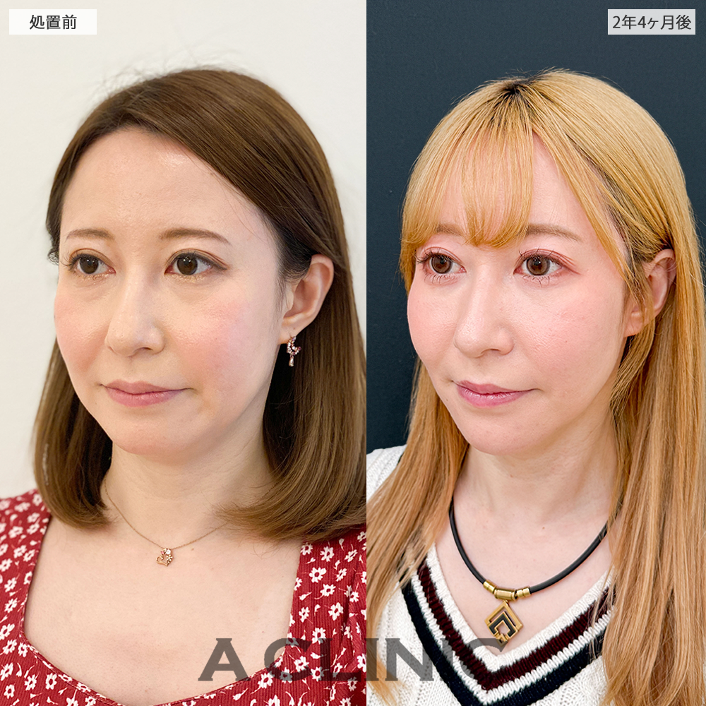 1day小顔脂肪吸引なら長期経過後も美しい輪郭をキープ！処置前と2年4ヶ月後の症例です(30代女性)