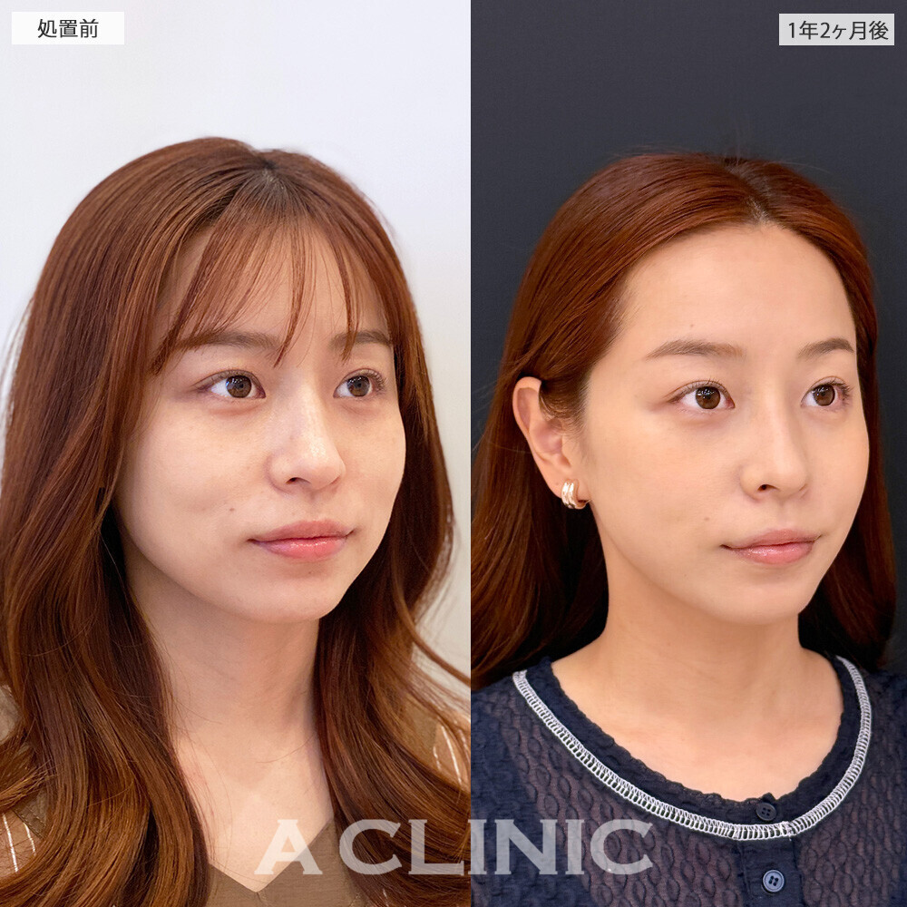 1day小顔脂肪吸引で何年経っても小顔続く！こちら処置前と1年2ヶ月後の症例です(30代女性)