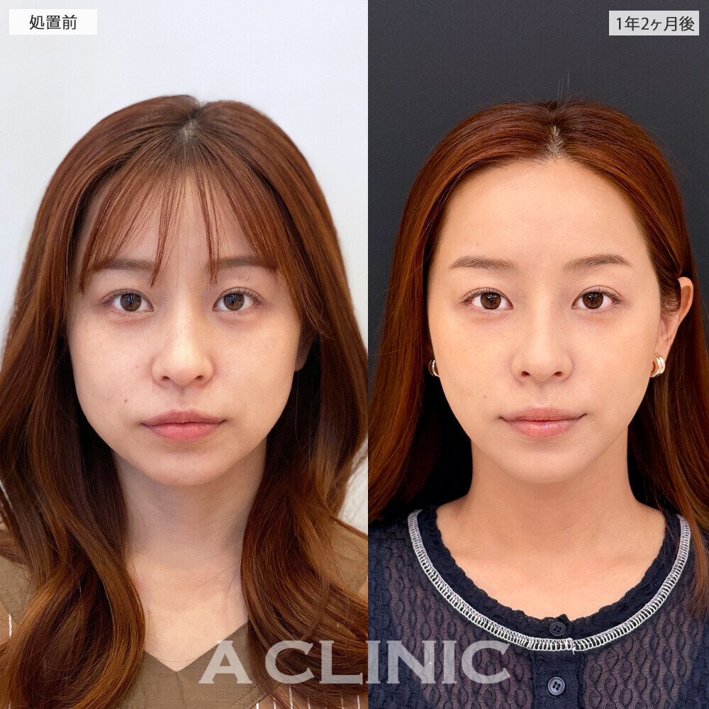 1day小顔脂肪吸引で何年経っても小顔続く！こちら処置前と1年2ヶ月後の症例です(30代女性)