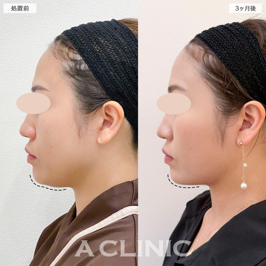 1day小顔脂肪吸引でお顔が一回り小さくなりました！処置前と3ヶ月後の症例です(30代女性)