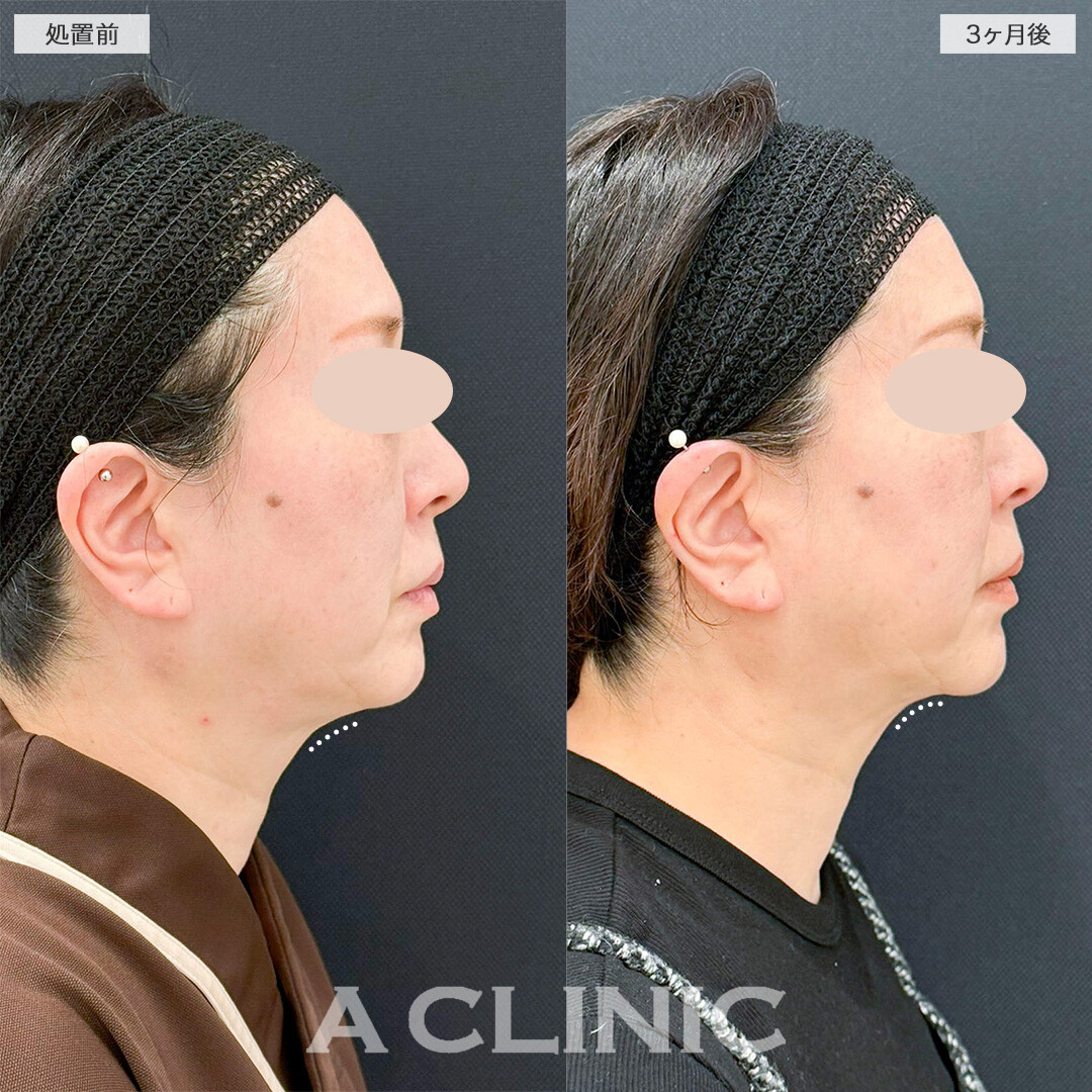 1day小顔脂肪吸引であご下のぼやけた感じが改善！処置前と3ヶ月後の症例です(50代女性)