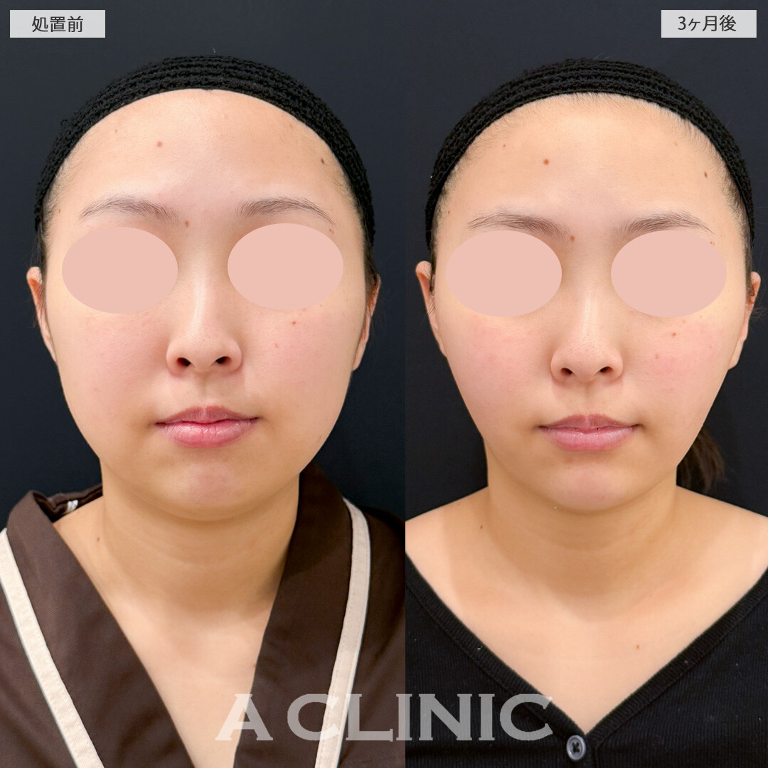 1day小顔脂肪吸引とバッカルファット除去術とあごへのヒアルロン酸注入でダイエットよりも短期間で顔痩せに成功！処置前と3ヶ月後の症例です(20代女性)
