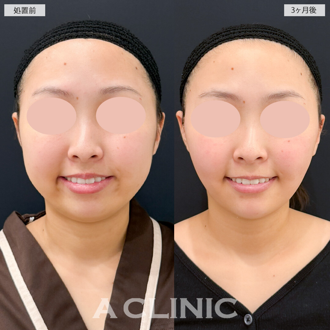 1day小顔脂肪吸引とバッカルファット除去術とあごへのヒアルロン酸注入でダイエットよりも短期間で顔痩せに成功！処置前と3ヶ月後の症例です(20代女性)