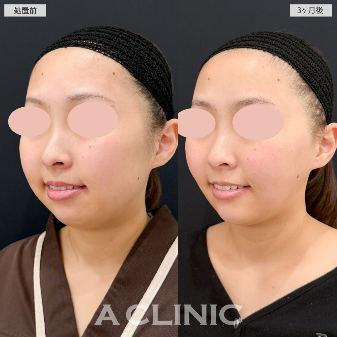 1day小顔脂肪吸引とバッカルファット除去術とあごへのヒアルロン酸注入でダイエットよりも短期間で顔痩せに成功！処置前と3ヶ月後の症例です(20代女性)
