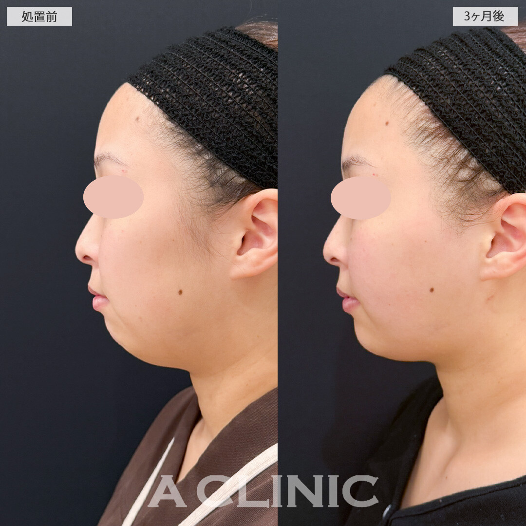 1day小顔脂肪吸引とバッカルファット除去術とあごへのヒアルロン酸注入でダイエットよりも短期間で顔痩せに成功！処置前と3ヶ月後の症例です(20代女性)