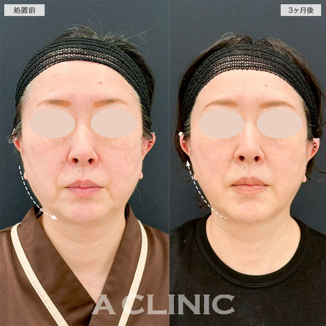1day小顔脂肪吸引であご下のぼやけた感じが改善！処置前と3ヶ月後の症例です(50代女性)