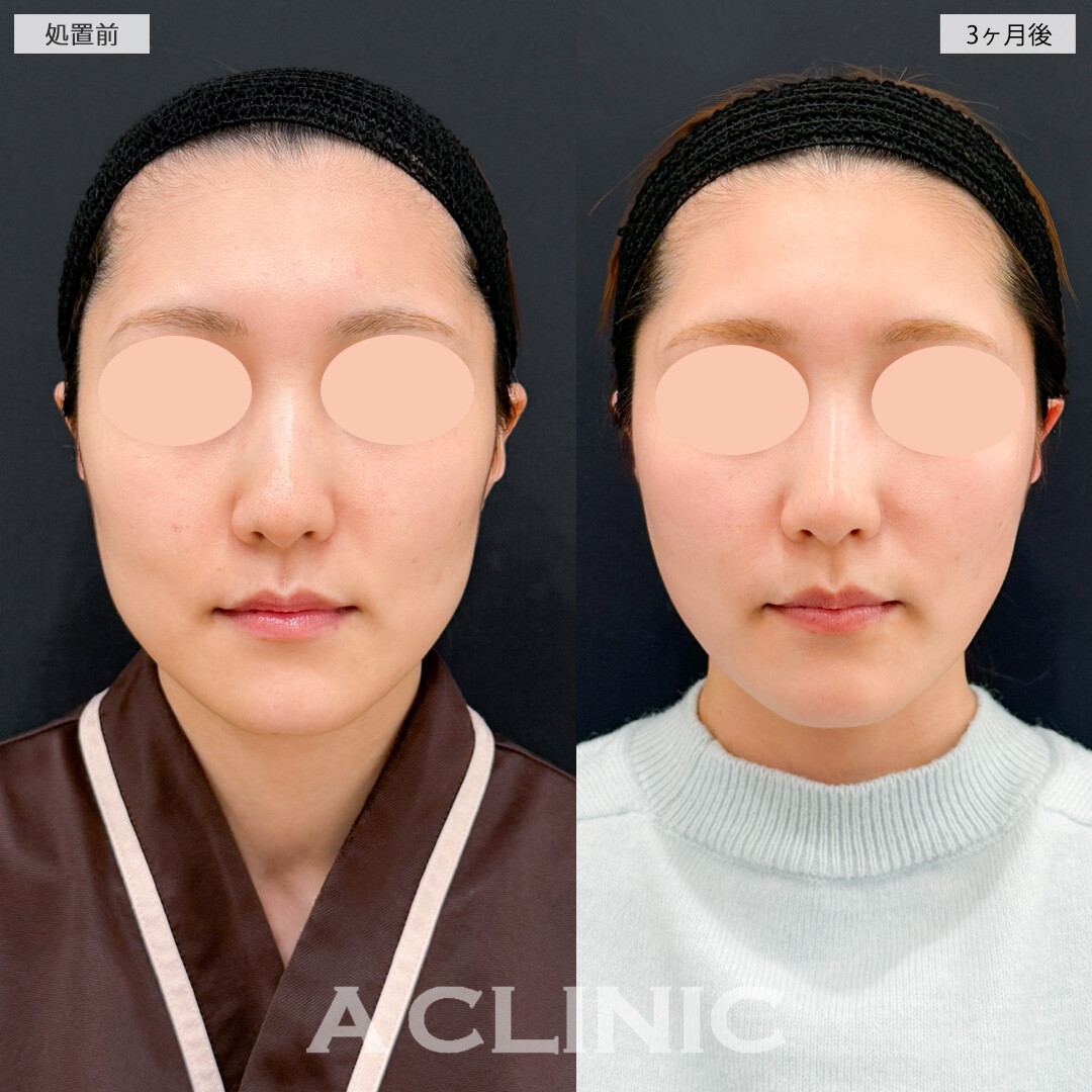 1day小顔脂肪吸引とナゾラビアルファット除去術とバッカルファット除去術で落としづらいお顔の脂肪にも効果的！処置前と３ヶ月後の症例です(30代女性)