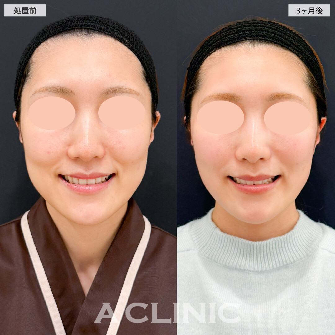 1day小顔脂肪吸引とナゾラビアルファット除去術とバッカルファット除去術で落としづらいお顔の脂肪にも効果的！処置前と３ヶ月後の症例です(30代女性)