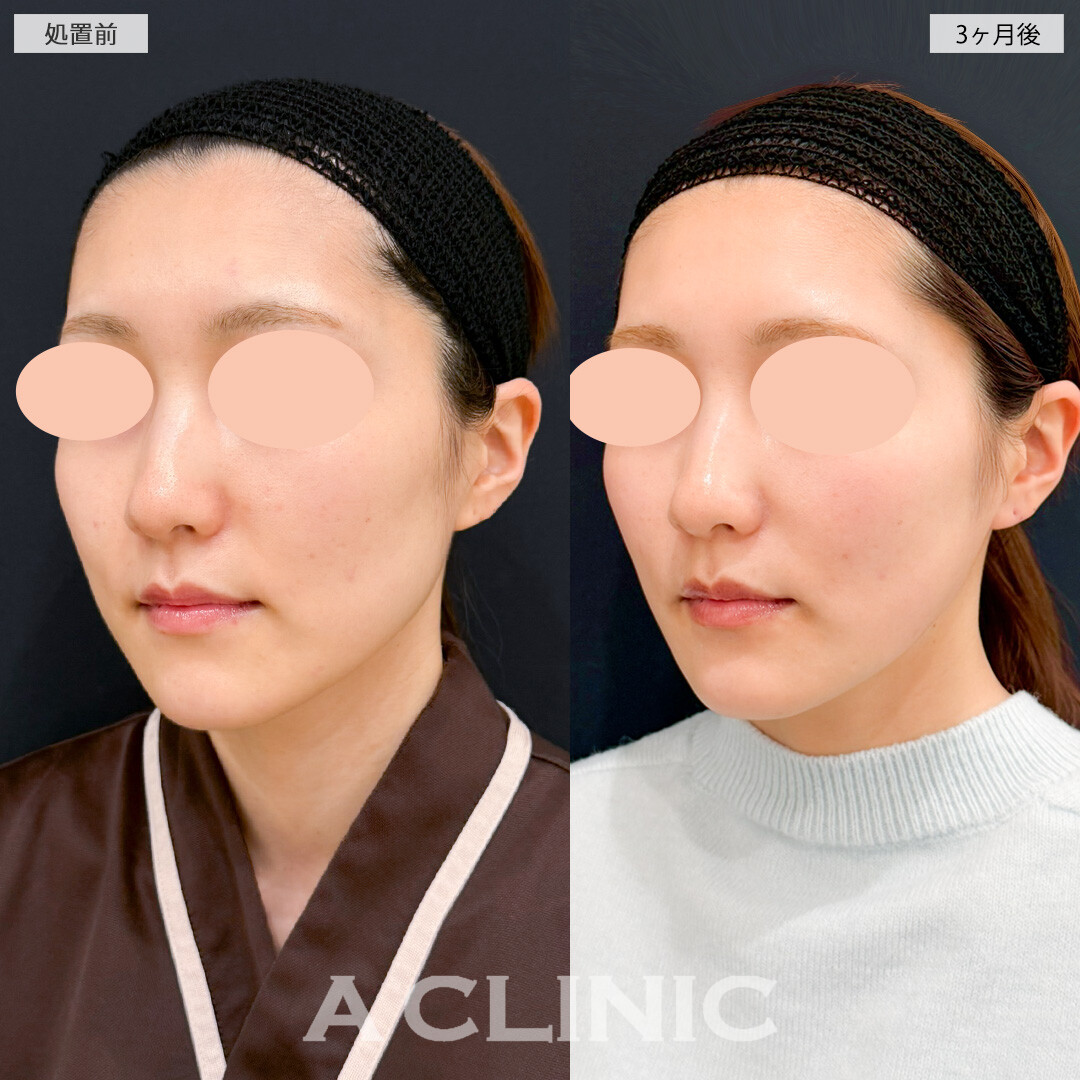 1day小顔脂肪吸引とナゾラビアルファット除去術とバッカルファット除去術で落としづらいお顔の脂肪にも効果的！処置前と３ヶ月後の症例です(30代女性)