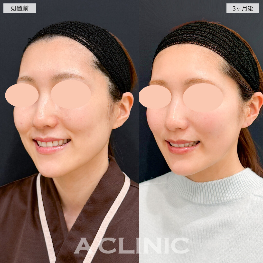 1day小顔脂肪吸引とナゾラビアルファット除去術とバッカルファット除去術で落としづらいお顔の脂肪にも効果的！処置前と３ヶ月後の症例です(30代女性)