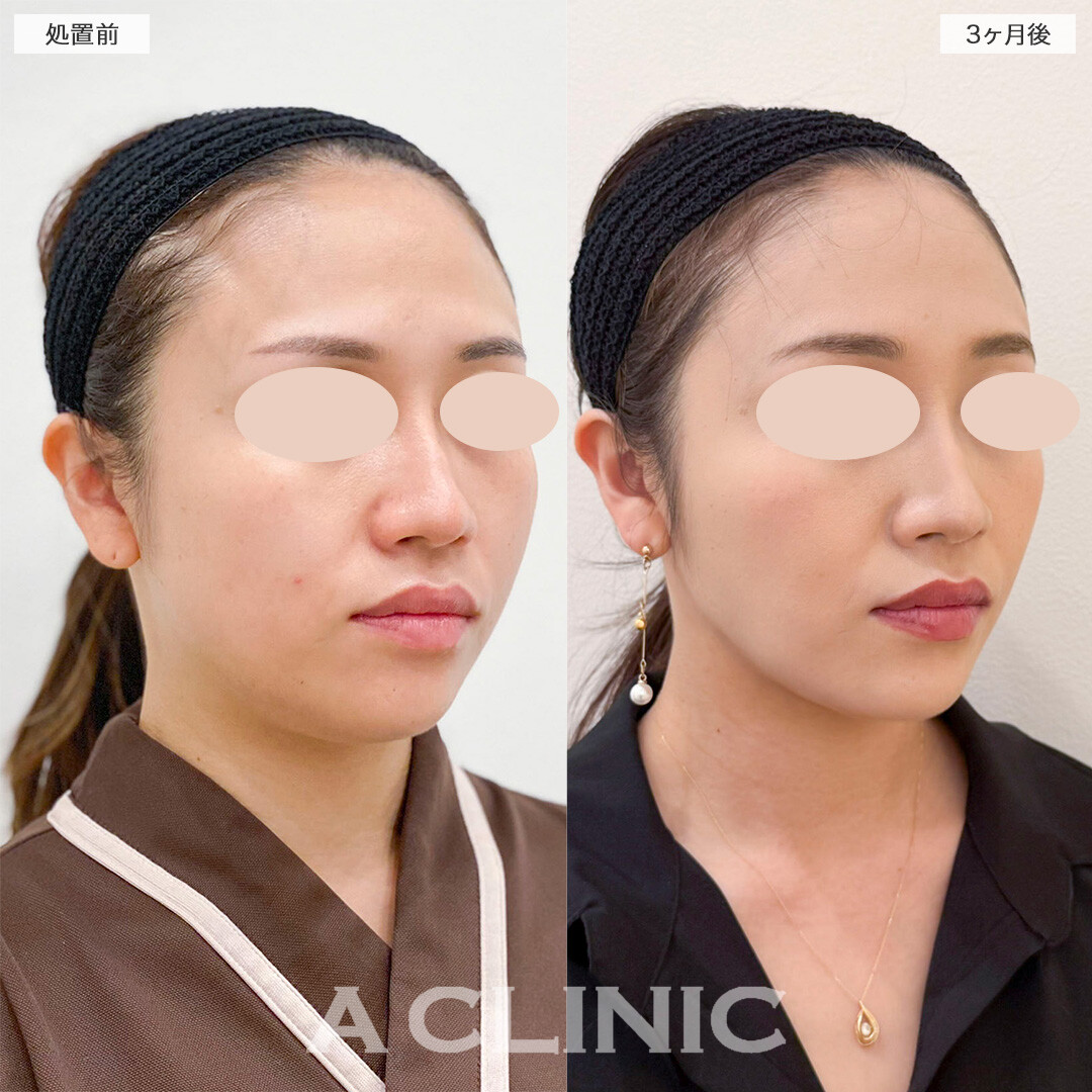 1day小顔脂肪吸引でお顔が一回り小さくなりました！処置前と3ヶ月後の症例です(30代女性)